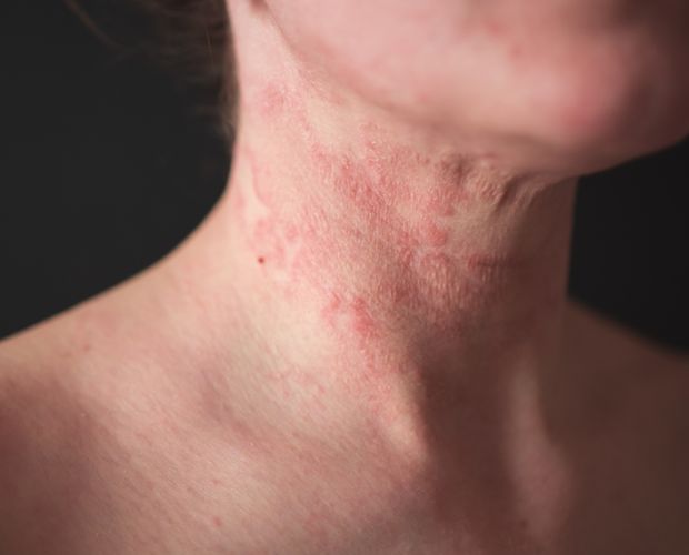 Eczema